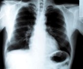 Smoker Lungs X-Ray