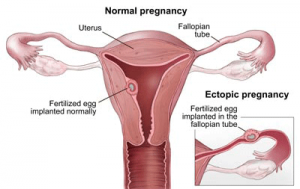 Image of Ectopic Pregnancy - Courtesy Mayo Foundation